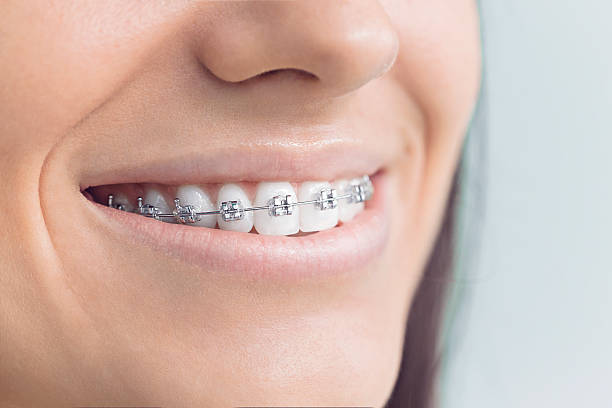 Dental Bonding in Carlisle Rockledge, AL